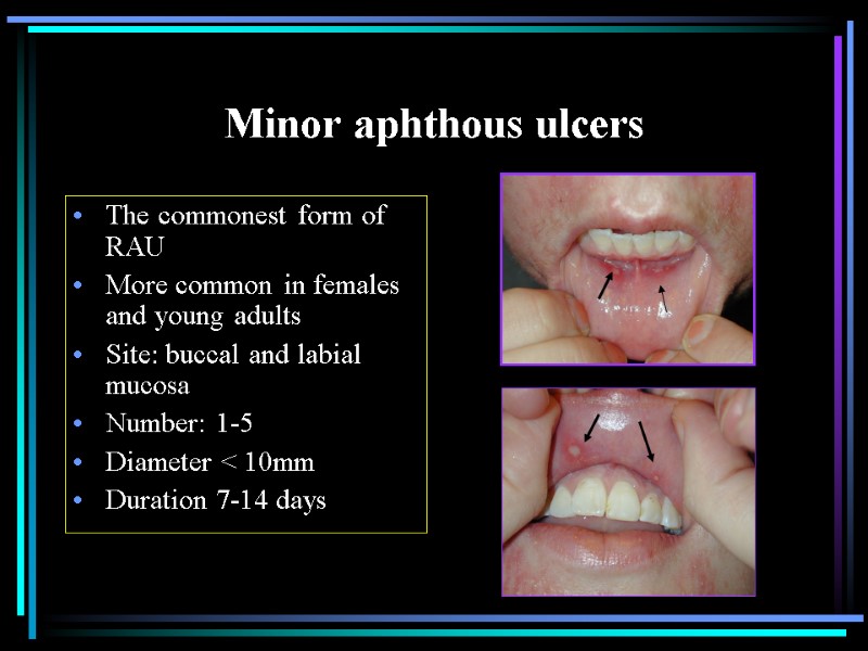 Minor aphthous ulcers The commonest form of RAU More common in females and young